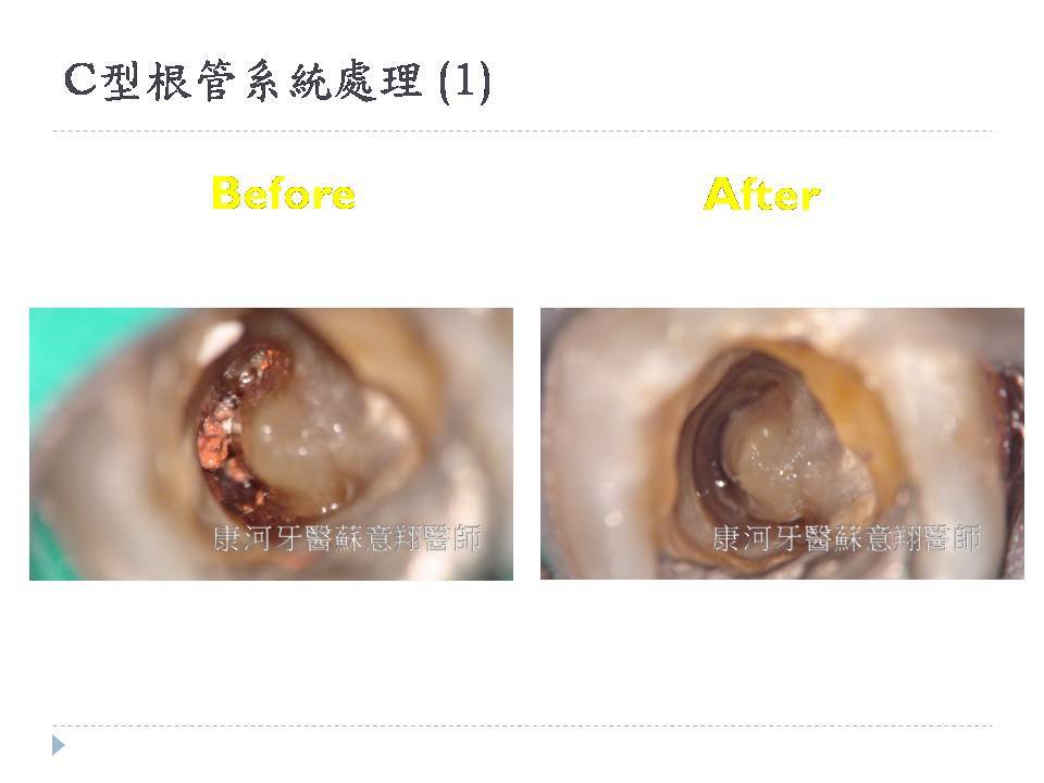 顯微根管專區