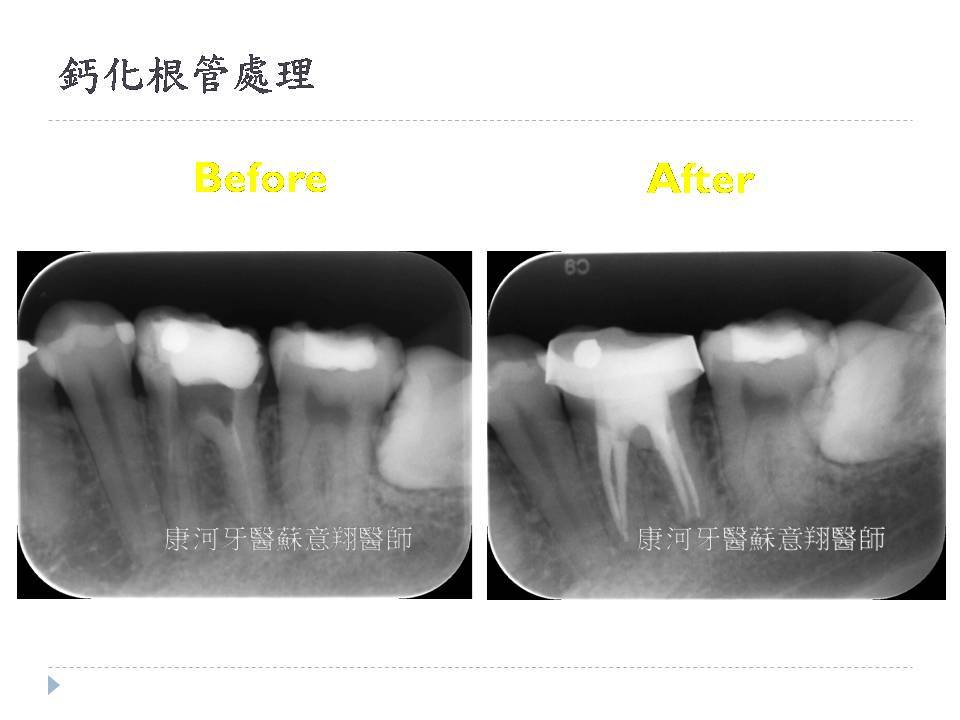 顯微根管專區