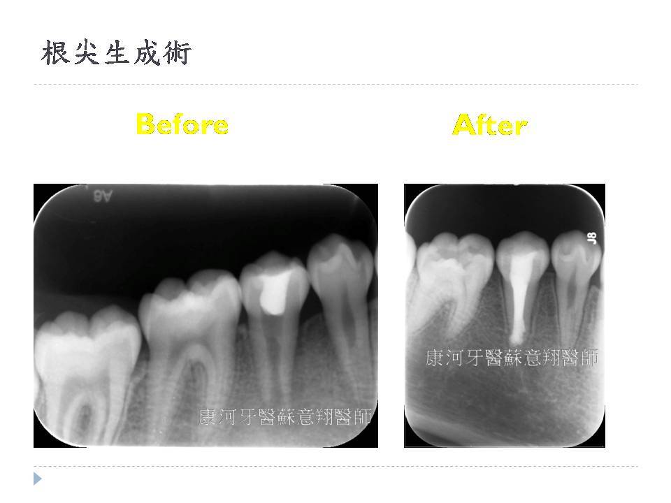 顯微根管專區