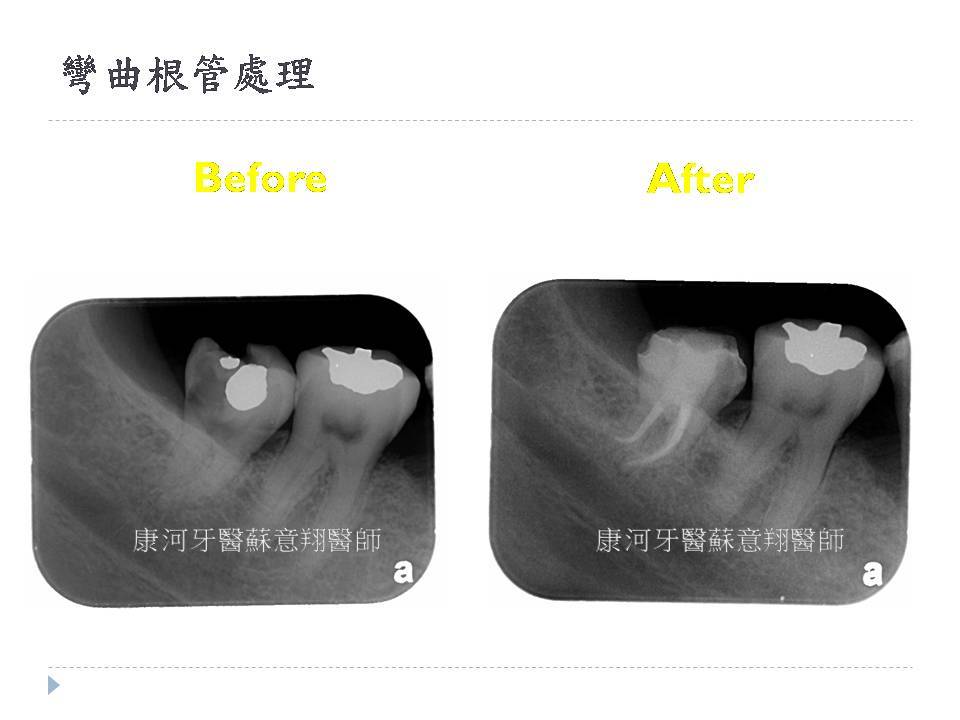 顯微根管專區