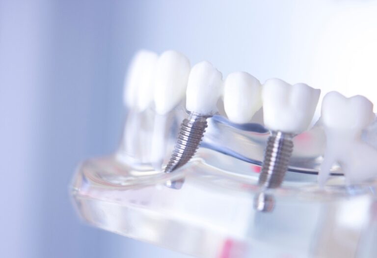 Dental Implants001 c