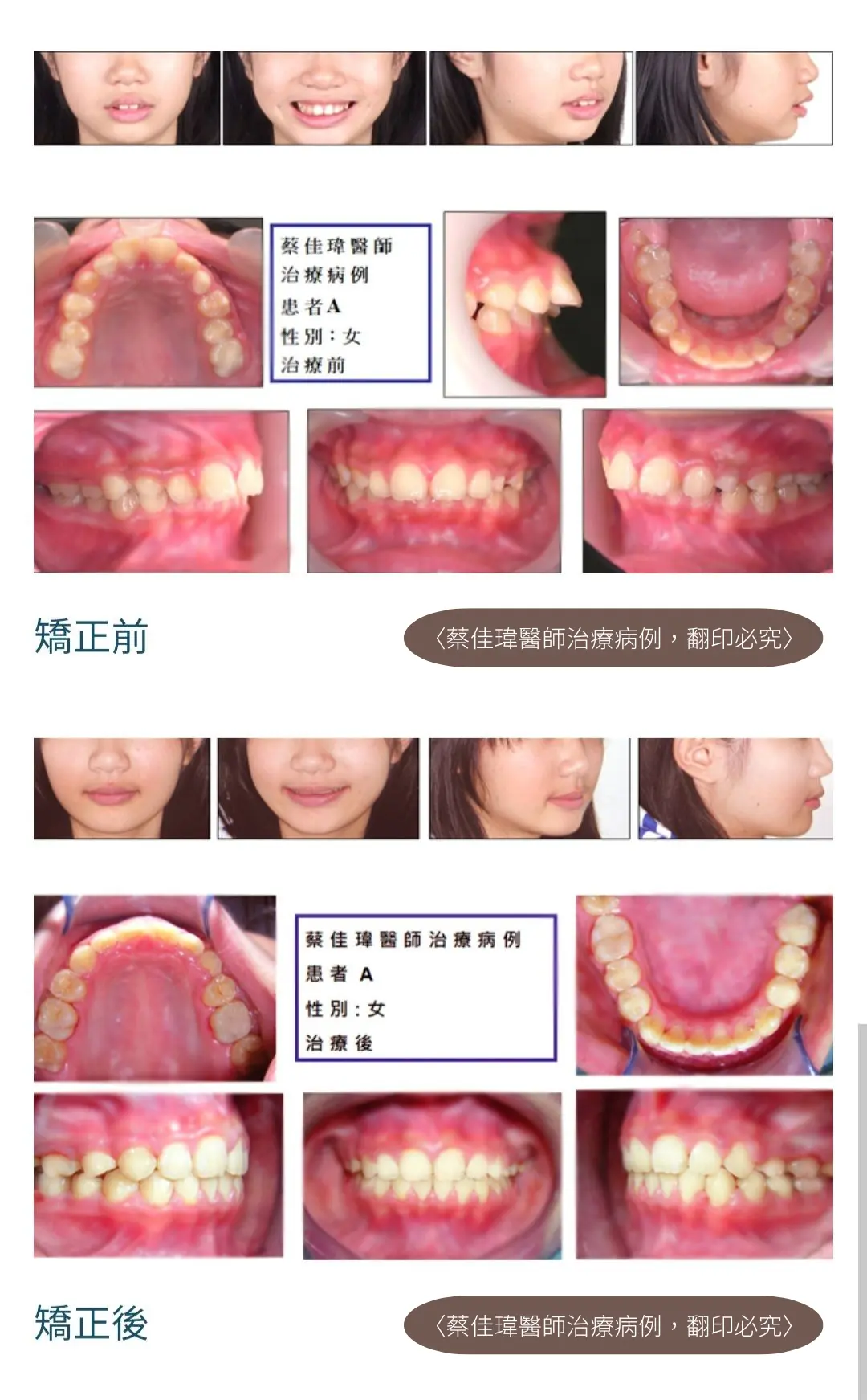 牙齒矯正 1 625