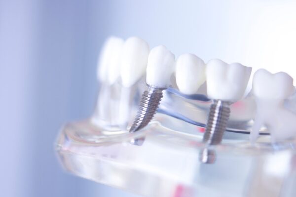 Dental Implants001_c